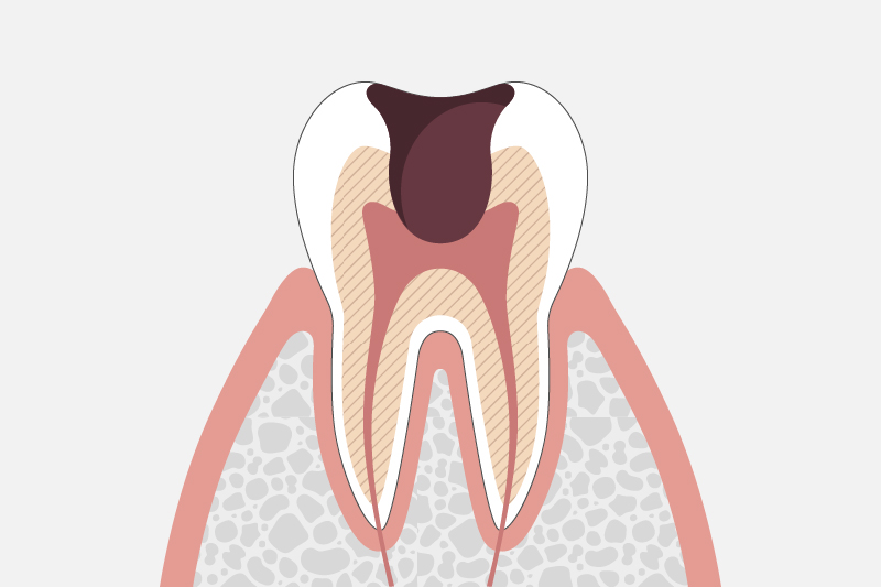 歯髄（神経)に達した虫歯