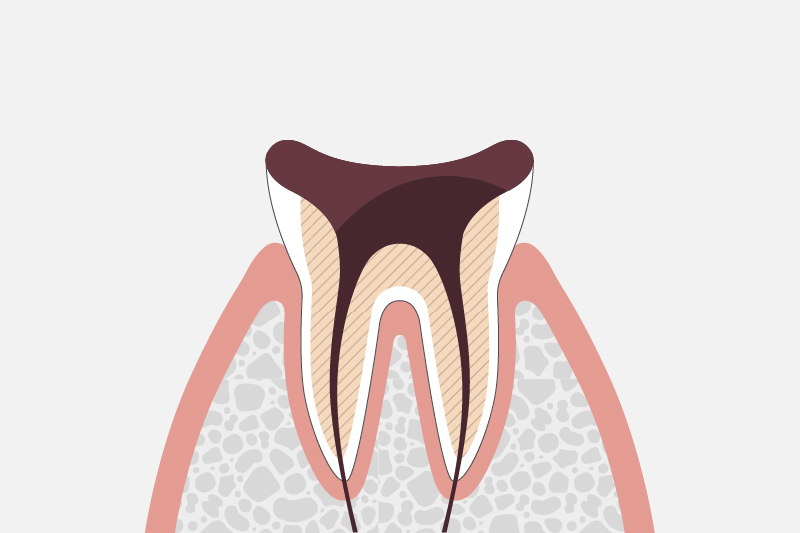 歯冠が崩壊した虫歯