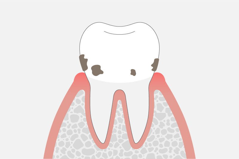 歯肉炎
